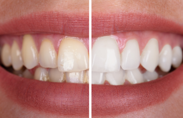 dental garden stomatolog bydgoszcz wybielanie zebów białe zęby
